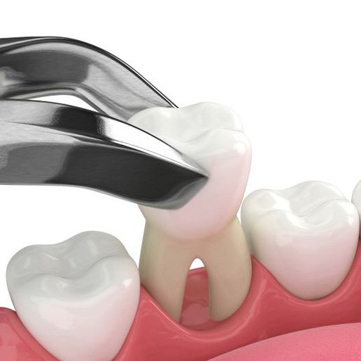 Illustration of dental forceps extracting a tooth