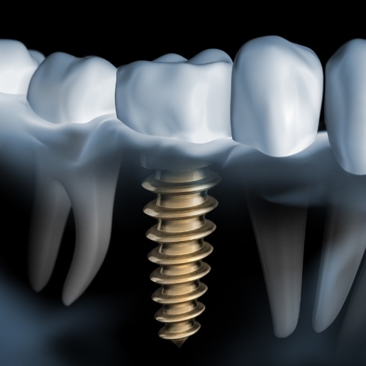 Animated dental X ray of a person with a dental implant in Merrillville