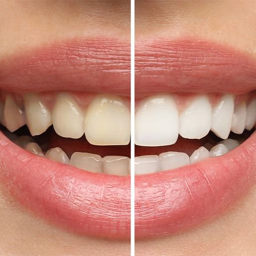 Before and after teeth whitening 